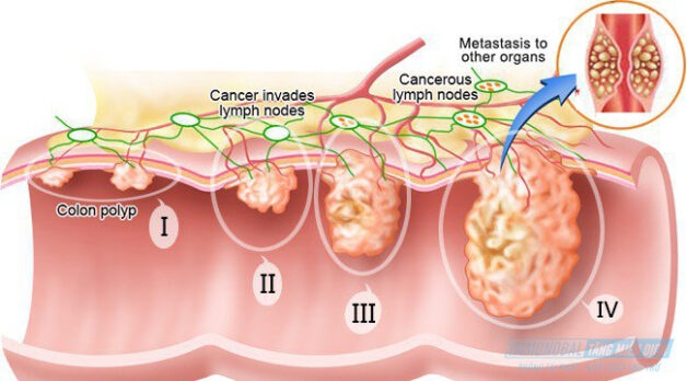 triệu chứng ung thư thực quản giai đoạn IV