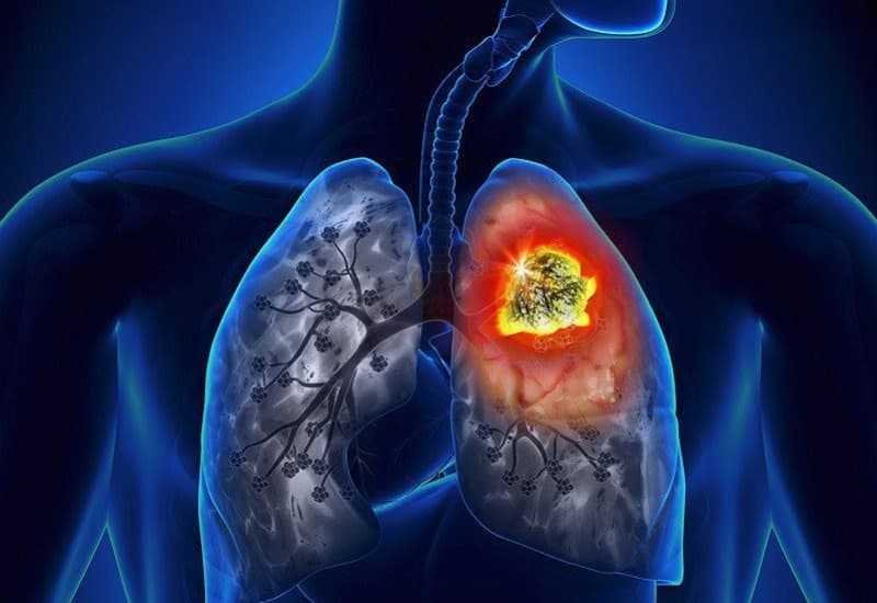 Ung thư phổi giai đoạn cuối đã phát triển rộng ở hai bên phổi, có thể di căn đến não, xương, gan, tuyến thượng thận, thận