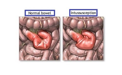 Lồng ruột là nguyên nhân hàng đầu gây tắc ruột ở trẻ nhỏ.