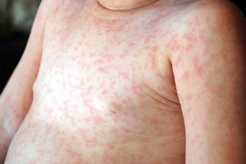 Sởi, rubella là bệnh truyền nhiễm cấp tính do virus gây ra. Bệnh lây theo đường hô hấp qua và dễ lây lan thành dịch