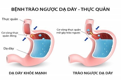 Trào ngược dạ dày thực quản là bệnh lý khá phổ biến nhiều người mắc phải