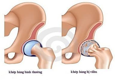 Viêm khớp háng ở nguời lớn, nguyên nhân và cách điều trị