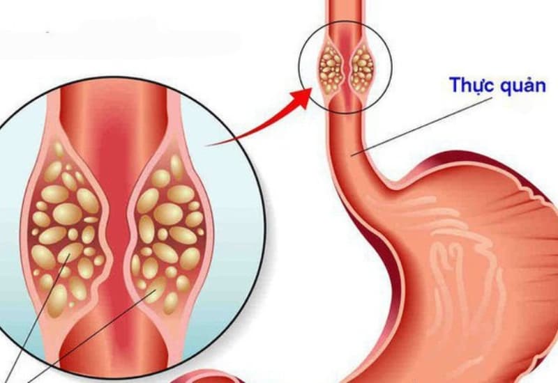 Ung thư thực quản phổ biến trong các bệnh ung thư đường tiêu hóa