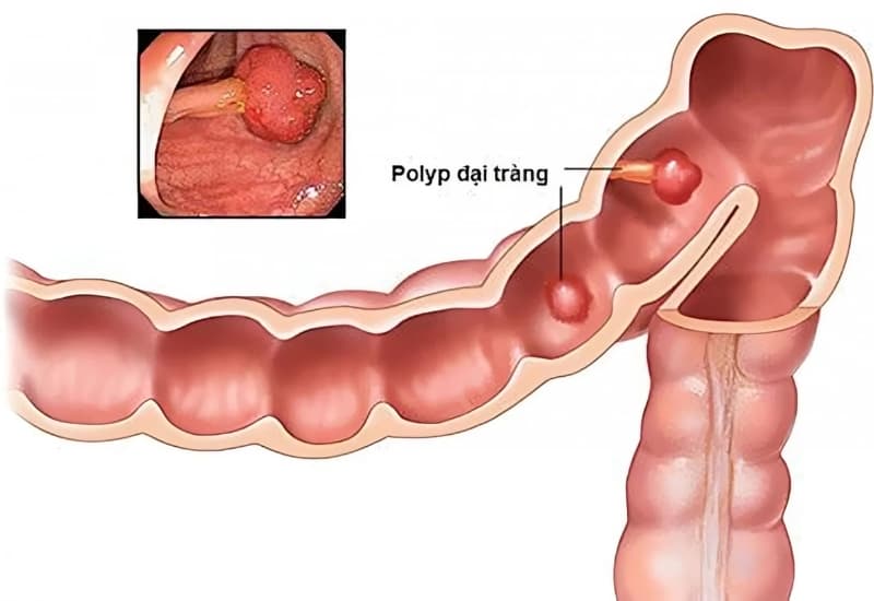 Polyp đại tràng là một khối nhỏ các tế bào hình thành trên lớp lót của đại tràng