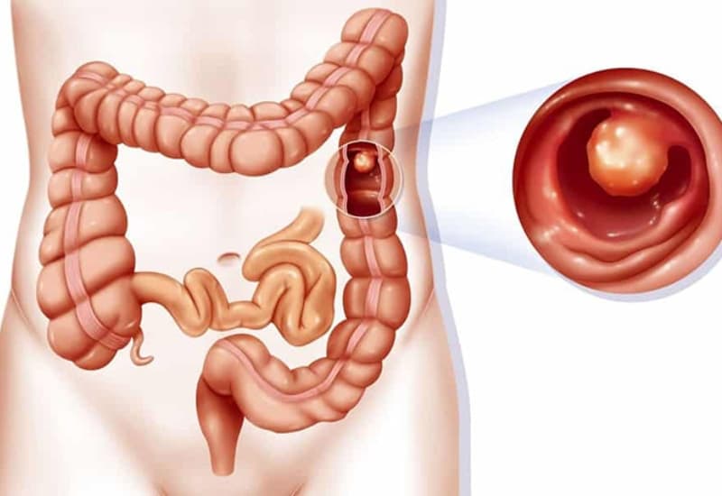 Phân mềm hoặc nát nhưng có máu kèm theo là triệu chứng polyp đại tràng