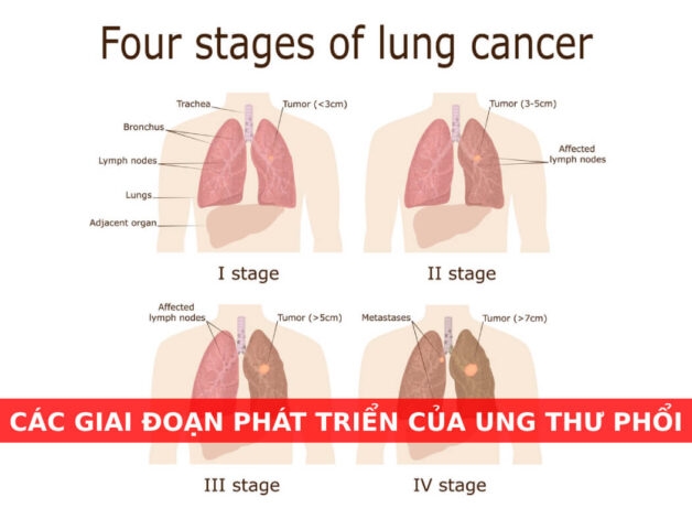 dấu hiệu ung thư phổi giai đoạn 2