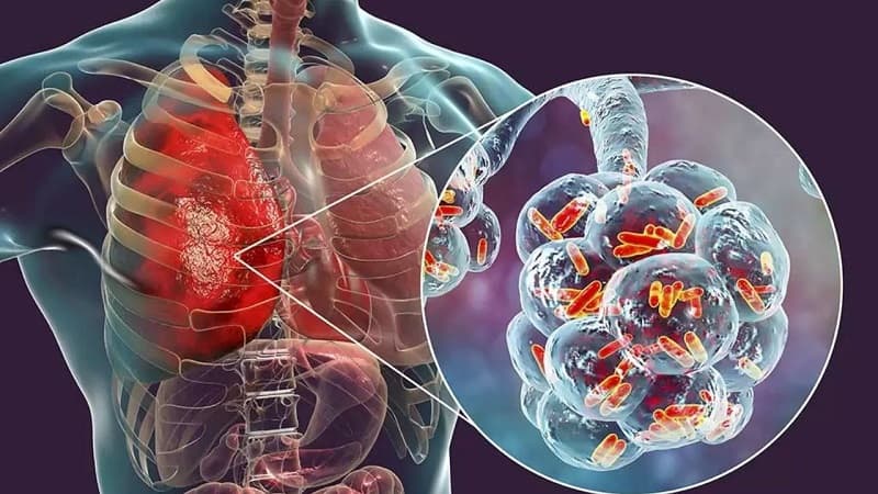 Ung thư phổi giai đoạn I