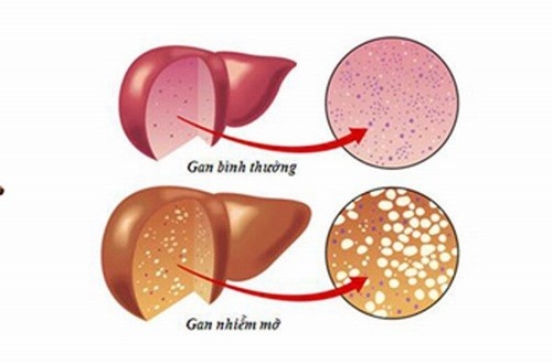 Bệnh gan nhiễm mỡ có thể điều trị bằng biện pháp không dùng thuốc