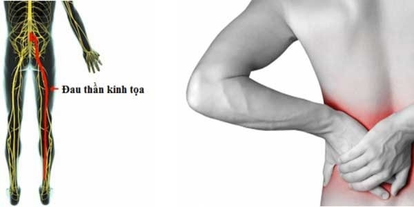 nguyen-nhan-va-trieu-chung-dau-than-kinh-toa-1
