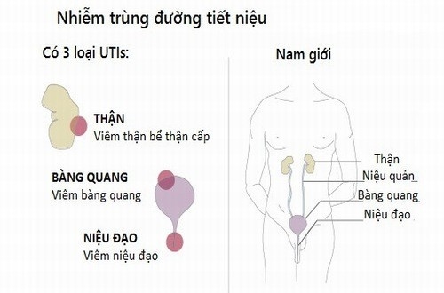 Nhiễm trùng đường tiểu cần được phát hiện sớm tránh biến chứng nguy hiểm ảnh hưởng sức khỏe