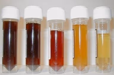 Nước tiểu màu vàng nguyên nhân do đâu?cần biết ngay bệnh