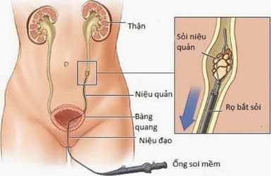 Tiểu ra máu sau tán sỏi niệu quản do đâu