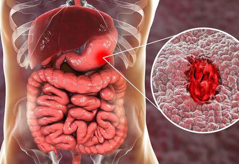 Xuất huyết dạ dày là bệnh nguy hiểm nếu không được phát hiện và điều trị kịp thời