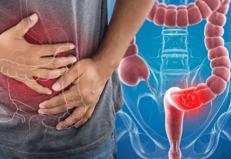 Ung thư đại tràng là bệnh nguy hiểm nhất ở đại tràng mà người bệnh không được chủ quan