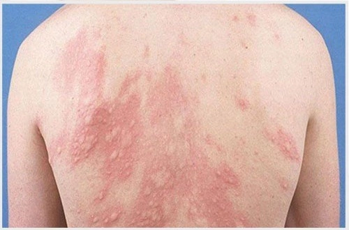 Nổi mẩn ngứa khắp người có thể do nhiều nguyên nhân gây ra