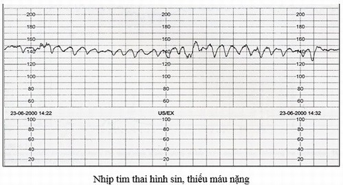 Nhịp tim cho thấy thai nhi đang bị thiếu máu nặng.