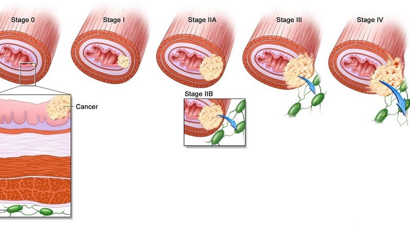 Ung thư thực quản giai đoạn 3A