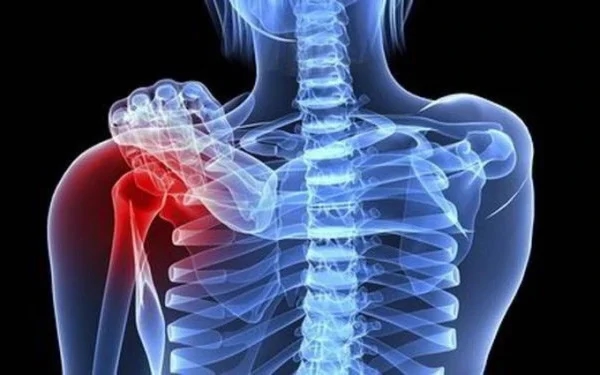 Tình trạng ung thư vú di căn đến xương ở phụ nữ