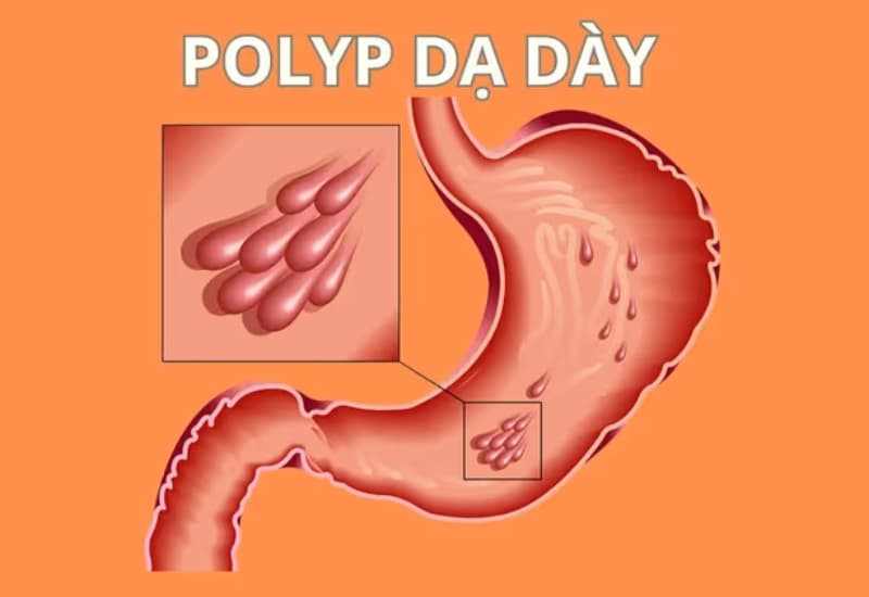 Polyp dạ dày hình thành do nhiều nguyên nhân, yếu tố nguy cơ khác nhau