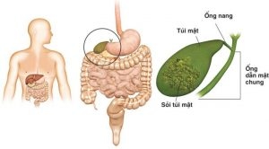 Sỏi mật hình thành chủ yếu từ sự kêt tụ của cholesterol, do mất cân bằng của các thành phần có trong dịch mật như cholesterol, billirubin, muối canxi...