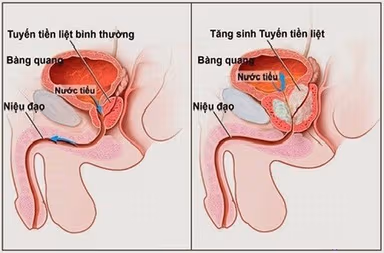 Cách chữa tiểu nhiều lần đúng cách, phù hợp