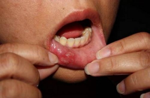 Có vết loét bất thường là một trong những biểu hiện ung thư khoang miệng thường gặp