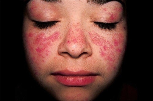 Lupus ban đó hệ thống cần được phát hiện sớm điều trị đúng cách tránh lây lan và gây biến chứng