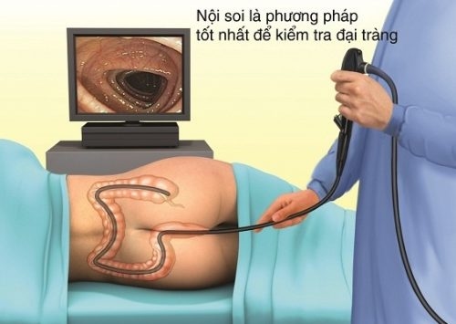 Nội soi là phương pháp kiểm tra đại tràng tốt nhất.