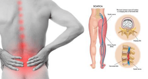 Đau thần kinh tọa là là một tình trạng đau lưng gây ra do dây thần kinh tọa bị chèn ép hoặc tổn thương.