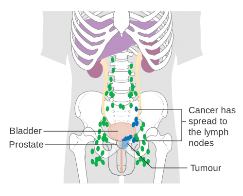 Ung thư tiền liệt tuyến giai đoạn cuối