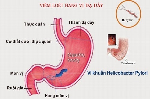 Viêm hang vị dạ dày là bệnh phổ biến nhiều người mắc phải