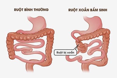 Xoắn ruột là gì?| Biểu hiện và điều trị