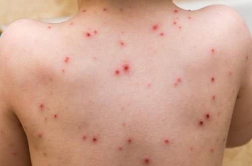 Bệnh thủy đậu do virus varicella zoster gây ra cần được phát hiện sớm và điều trị hiệu quả