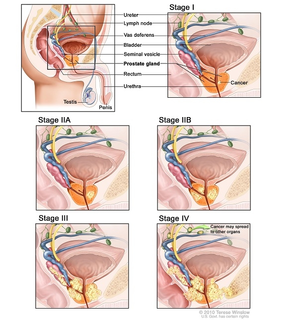 Các giai đoạn ung thư tuyến tiền liệt
