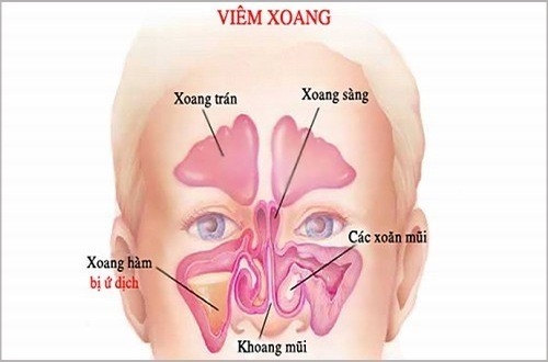 Người bệnh viêm xoang hàm cần được phát hiện sớm và điều trị kịp thời hiệu quả