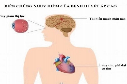 Bệnh huyết áp cao nếu không được kiểm soát tốt có thể gây biến chứng nguy hiểm