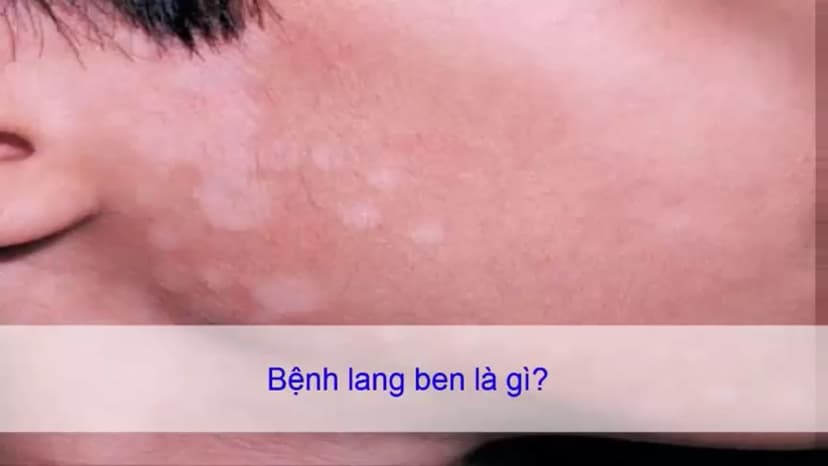 Lang ben có lây không?nguyên nhân nào dẫn đế lang ben