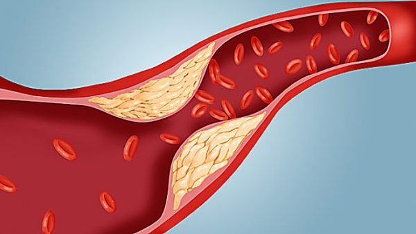 Người mỡ máu cao không được ăn trứng đúng hay sai?