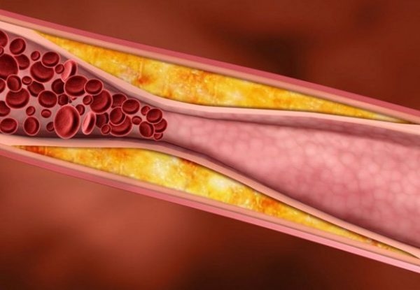 Xơ vữa động mạch là tổn thương trong đó có một khối vật chất bất thường tạo thành bên trong động mạch