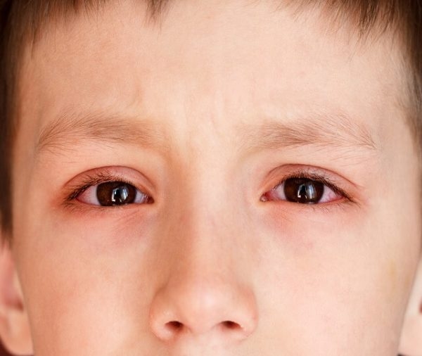 Nóng nực, độ ẩm cao là điều kiện để bệnh đau mắt đỏ phát triển mạnh.