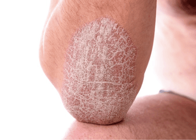 Những lưu ý trong điều trị bệnh vảy nến