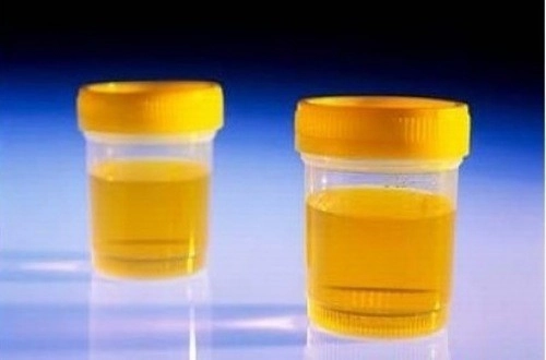 Màu sắc nước tiểu cũng chỉ điểm tình trạng sức khỏe của bạn