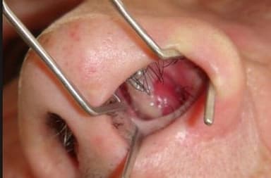 Polyp mũi nguy hiểm không? ảnh hưởng đến sức khỏe