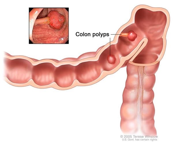 Polyp đại tràng là dạng tổn thương nhô vào lòng đại trực tràng, xuất phát từ niêm mạc
