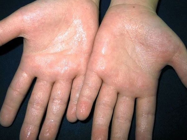 Bệnh ra mồ hôi tay, chân là loại bệnh về cường giao cảm thần kinh