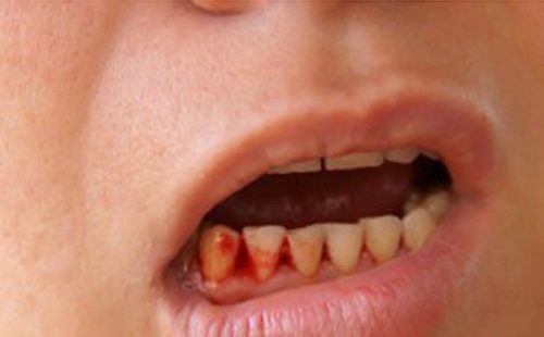 Chảy máu chân răng là một trong những triệu chứng của sốt xuất huyết.