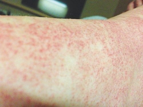 4 chủng sốt xuất huyết này có thể khiến người bệnh mắc rồi vẫn có thể mắc lại, thậm chí lần sau còn nặng hơn lần trước.