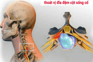 Thoát vị đĩa đệm cột sống cần được phát hiện sớm và điều trị hiệu quả tránh biến chứng ảnh hưởng sức khỏe