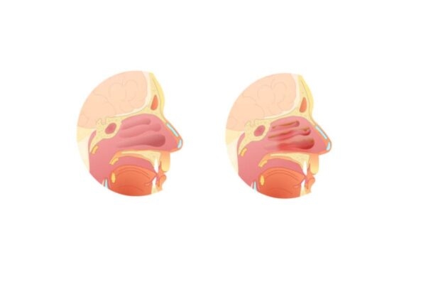 Tình trạng tổn thương niêm mạc mũi dẫn tới sưng nề được gọi là viêm mũi phù nề