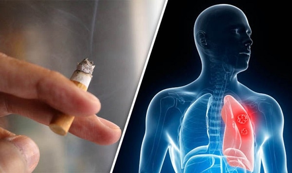 Thuốc lá là nguyên nhân gây ung thư phổi phổ biến hàng đầu ở nam giới